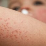 Cara Ampuh Mengatasi Biang Keringat Pada Bayi dan Anak