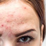 Fungal Acne: Beda dari Beruntusan, Ini Cara Menghilangkannya!