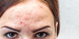 Fungal Acne: Beda dari Beruntusan, Ini Cara Menghilangkannya!