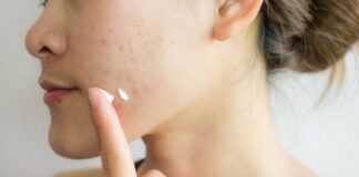 11 Salep Jerawat Terbaik: Ampuh Basmi Jerawat Tanpa Bekas