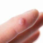 6 Obat Kutil di Apotik: Ampuh dan Hilang Lebih Cepat