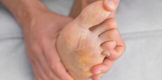 Kutu Air: Infeksi Jamur Menular di Kaki dan Tangan