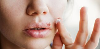 Apakah Herpes Bisa Sembuh? Ketahui Fakta Pemulihannya