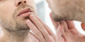 Apakah Herpes Menular? Ini 5 Kemungkinannya