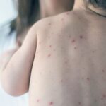 Mengenal Herpes, Penyakit Kulit Menular akibat Virus