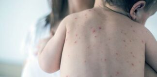 Mengenal Herpes, Penyakit Kulit Menular akibat Virus