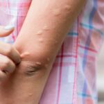 Biduran, Gatal Memerah yang Bisa ke Sekujur Tubuh