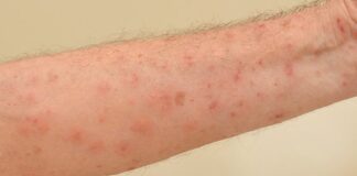 Scabies, Kulit Gatal yang Cepat Menyebar dan Menular