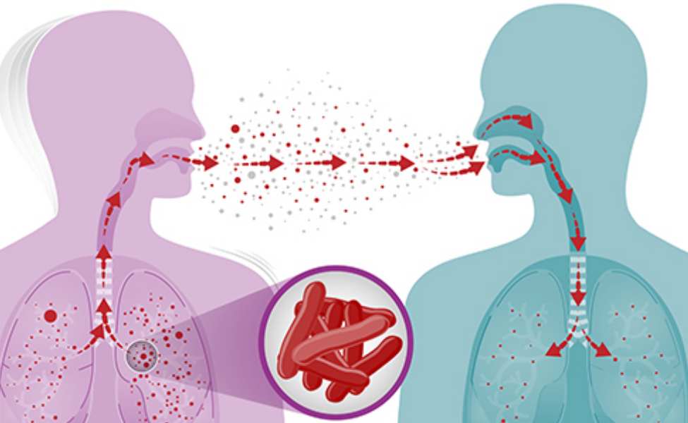 Faktor Penyebab Penyakit Tuberkulosis