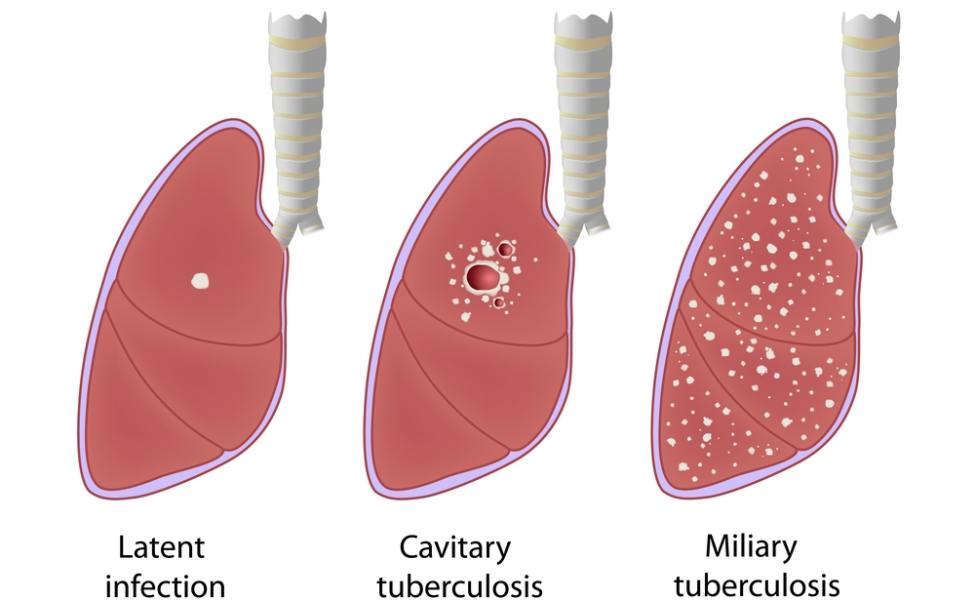 jenis-jenis tuberkulosis