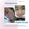 Gambar Paket Acne MS GLOW ( Solusi Wajah Berjerawat ) dari Toko Skincare Indonesia Jakarta Barat 3 Tokopedia