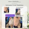 Gambar Teratu Beauty Intensive Acne Solutions Totol Jerawat TeratuBeautyBogor dari Teratu Beauty Agen Bogor Kab. Bogor 4 Tokopedia