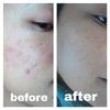 Gambar cream malam jerawat / krem jerawat / Lavees Acne night cream 10gr dari lavees skin health care Kota Bekasi 4 Tokopedia