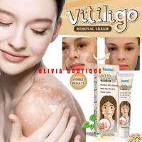 cream vitiligo/vitiligo natural