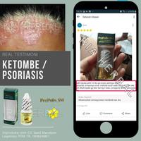 Gambar Obat Borok Di Kepala Tradisional,Pembasmi Jamur Pada Kulit,Bisul,Budug dari Ria Herbal Official undefined 4 Tokopedia