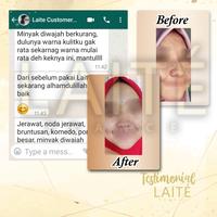 Gambar Laite Deluxe Paket Acne Series / Skincare Dokter Anti Jerawat BPOM MUI dari laitestore undefined 3 Tokopedia