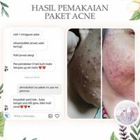 Gambar ms glow paket acne / acne ms glow / cream acne ms glow original dari sumber barokha undefined 2 Tokopedia