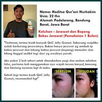Gambar Masker Alami Penghilang Bekas Jerawat (Bopeng), QnC Jelly Gamat dari Rayu Herbal Shop undefined 4 Tokopedia