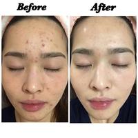 Gambar ORIGINAL OXY 10 - 25gr ORI ASLI Obat Jerawat Acne Cream Krim Oxi 25 gr dari RLY METTA SHOP undefined 5 Tokopedia