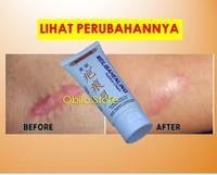 Gambar Krim Obat Penghilang Bekas Luka Bakar Koreng Cacar Hitam Merah Ampuh dari Obilo Store undefined 1 Tokopedia