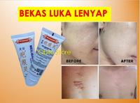 Gambar Krim Obat Penghilang Bekas Luka Bakar Koreng Cacar Hitam Merah Ampuh dari Obilo Store undefined 2 Tokopedia