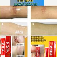 Gambar bahenling obat penghilang bekas luka koreng luka lama hitam dari Nadhira Alma undefined 1 Tokopedia