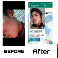 Gambar SERUM VITA OIL PENGHILANG BOPENG DAN FLEK HITAM - 1 botol dari Herbalstore_1 undefined 4 Tokopedia