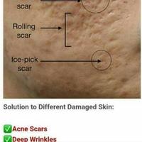 Gambar PAKET SET ALAT KECANTIKAN DERMAROLLER DENGAN SERUM DAN ANASTESI - 1mm dari Ukhtidotid undefined 3 Tokopedia