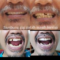 Gambar temptooth gigi palsu bisa dipakai makan. dari Pie99Shop undefined 3 Tokopedia