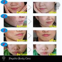 Gambar Bioaqua Pure Skin Krim Wajah Anti Acne Rejuvenation Cream 30g COD dari Psycho Body Care undefined 3 Tokopedia