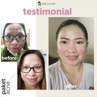 Gambar MS GLOW Acne Serum dari MS Glow Indonesia Store undefined 4 Tokopedia