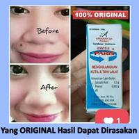 Gambar Swiss Paris Lotion ..Obat Penghilang Kutil Tahi Lalat Mata Ikan dari Herbal Harits undefined 5 Tokopedia