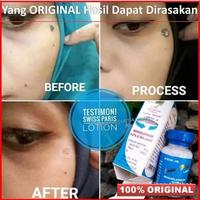 Gambar Swiss Paris Lotion ..Obat Penghilang Kutil Tahi Lalat Mata Ikan dari Herbal Harits undefined 2 Tokopedia