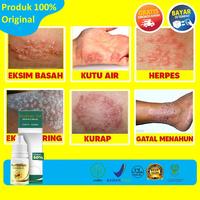 Gambar Obat Oles Gatal Panu Kadas Kudis Kurap Gudik Herpes Eksim Alergi Alami dari Asyiah Herbal undefined 1 Tokopedia