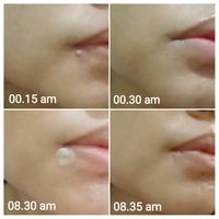 Gambar ORIGINAL COSRX Acne Pimple Master Patch (24 pcs) - Hitam dari Cilla Beauty Palace undefined 4 Tokopedia