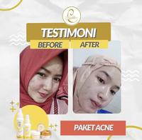 Gambar bebwhitec acne series bpom HALAL dari LauV_OS undefined 3 Tokopedia