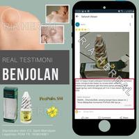 Gambar SALEP CAIR PENGHILANG BENJOLAN DI PUNGGUNG, LIPOMA TANGAN, LEHER OBAT dari Toko Myherbal undefined 3 Tokopedia