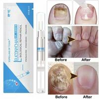 Gambar Salep Kuku Kaki dan Tangan Cantengan Obat Jamur Kuku Leuconychia Cream dari epe store undefined 1 Tokopedia