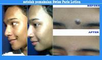 Gambar SWISS PARIS LOTION Obat Penghilang TAHI LALAT dan KUTIL dari infineedstore undefined 5 Tokopedia