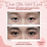Gambar Korean Double Eyelid 2 Benang Jakarta dari drkartika90 undefined 1 Tokopedia