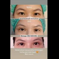 Gambar Korean Double Eyelid 2 Benang Jakarta dari drkartika90 undefined 3 Tokopedia