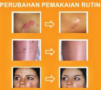 Gambar ORIGINAL Cream Penghilang Bekas Luka Lama Hitam Koreng Bopeng Jerawat dari Lovaribel Glowing undefined 4 Tokopedia