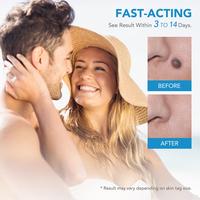 Gambar Alat Kutil Penghilang Tahi Lalat Skin Tag Remover Tools Kit Original - Sticker dari Jevan Rafael Shop undefined 2 Tokopedia