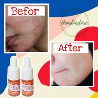 Gambar Softgel Serum Ampuh Hilangkan Flek Hitam Wajah kusam buy 1 get 1 dari BW Herbs undefined 3 Tokopedia