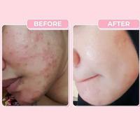 Gambar Softgel Serum Ampuh Hilangkan Flek Hitam Wajah kusam buy 1 get 1 dari BW Herbs undefined 5 Tokopedia
