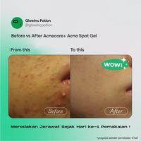 Gambar GLOWINC POTION ACNECORE+ Acne Spot Gel Glow.inc dari Coco_Bee_Store undefined 4 Tokopedia