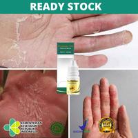 Gambar Obat Kulit Telapak Tangan Kering dan Kasar, Telapak Tangan Gatal dari Toko Aulia Herbal undefined 1 Tokopedia