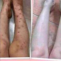 Gambar Cream Penghilang Bekas Luka tim Reguler dari Loveyourself_ undefined 1 Tokopedia