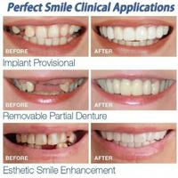 Gambar Gigi Palsu Veneers 1 Set Atas Bawah Merk Snap On Smile dari OCTOPUS ADVERTISING undefined 5 Tokopedia