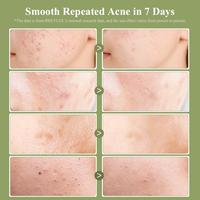 Gambar BREYLEE - BPOM TEA TREE SALICYLIC ACID CLEANING PADS - 40 Pads dari Hollapskin undefined 4 Tokopedia